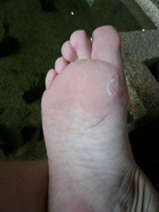 They ate off my blister!!
